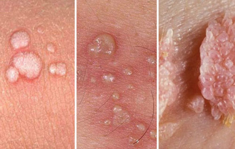 Treatment of genital warts in women: