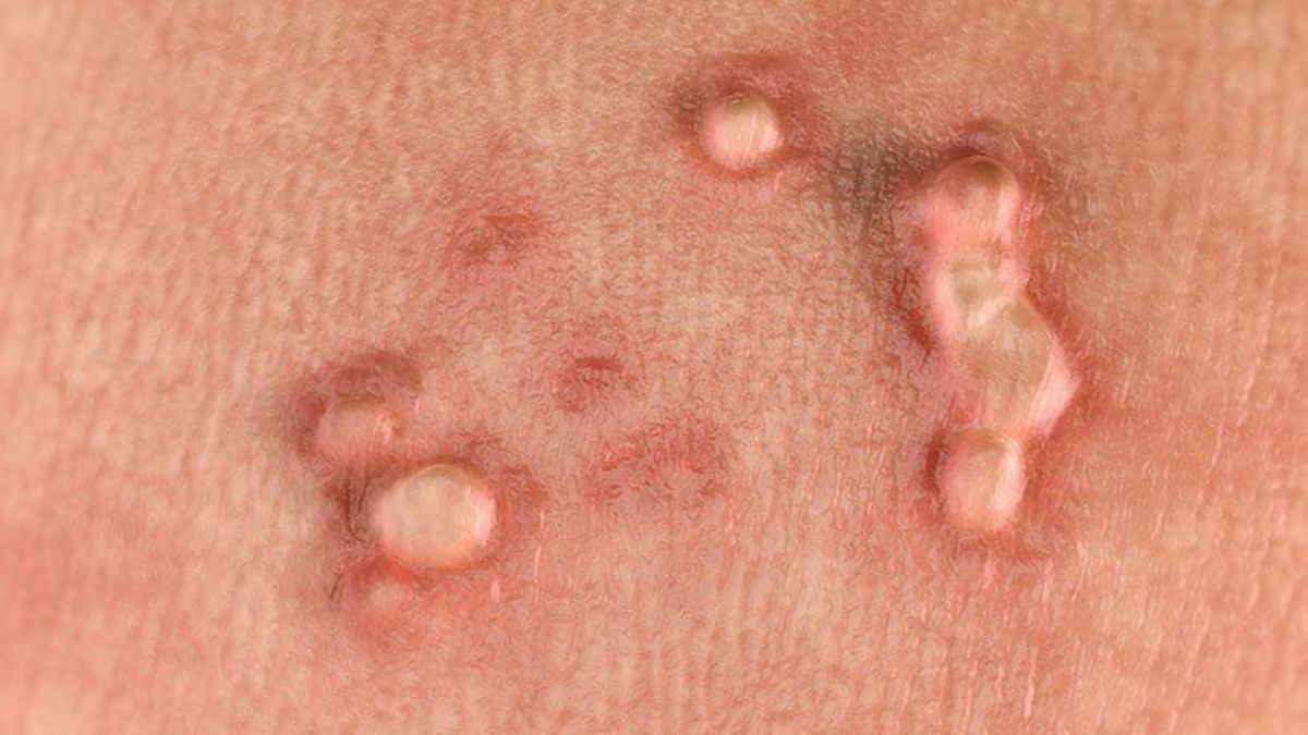 The definition of genital warts and their causes: