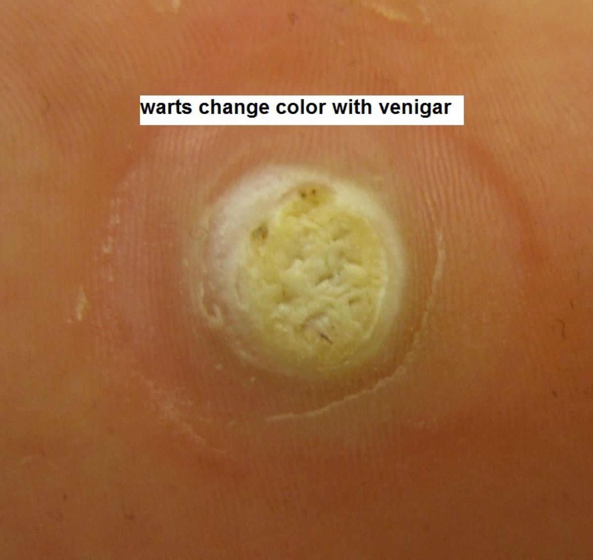 Hpv warts falling off