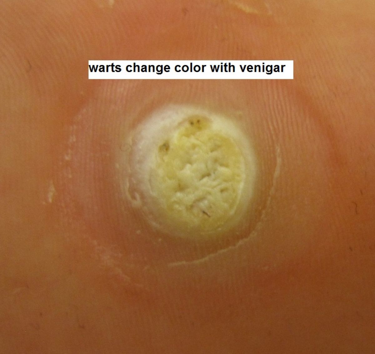 hpv wart falling off