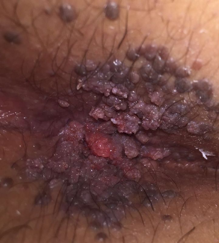 Baby Born With Warts On Anal Area - Anus genital picture wart - Nude Images...